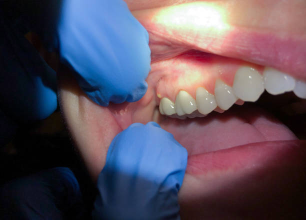 Best Emergency Care for Gum Disease in Ajo, AZ